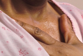 mellkas izzadás éjszaka a genitális szemölcsök onkológiai típusai