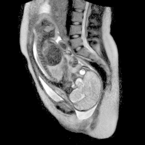 Először sikerült mágneses rezonancia tomográfiával felvételt készíteni szülés közben