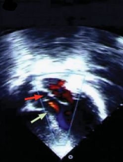 A Doppler endokarditiszt mutatott