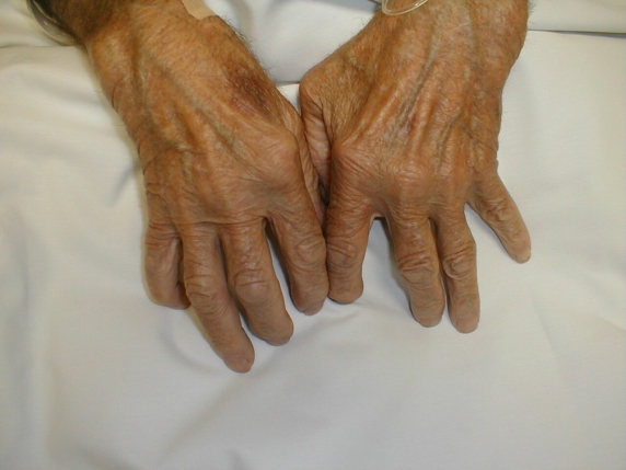 A rheumatoid arthritis Európában kétmillió, Magyarországon ötvenezer beteget érint