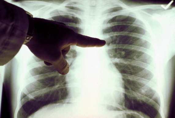 68,3 millió halál közül 11,9 milliót a tüdő betegségei (tbc, rák és tüdőgyulladás) okoznak