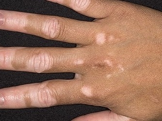 Vitiligó: pigmenthiány következtében szabálytalan alakú, világosabb foltok jelennek meg a bőrön