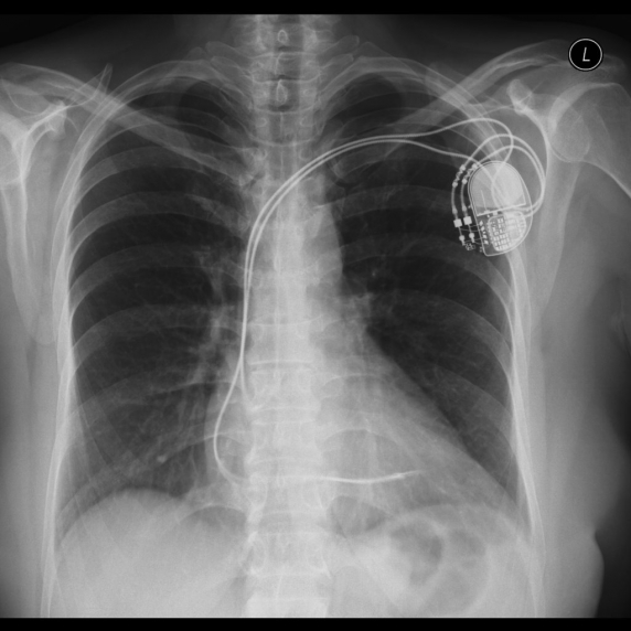 A korábban alkalmazott pacemakerek mellett nem volt lehetőség MRI vizsgálatra
